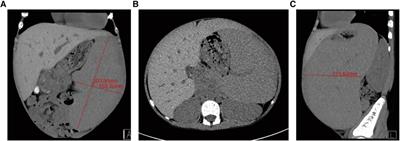 Single-incision laparoscopic splenectomy in children with massive splenomegaly: A prospective, monocentric pilot study